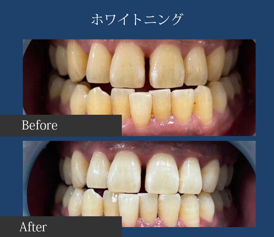 ホワイトニングビフォーアフター画像2