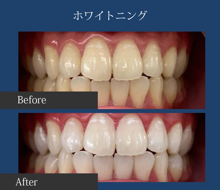 ホワイトニングビフォーアフター画像1